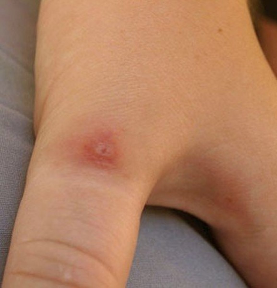 black-widow-spider-bite-pictures-stages-symptoms-treatment