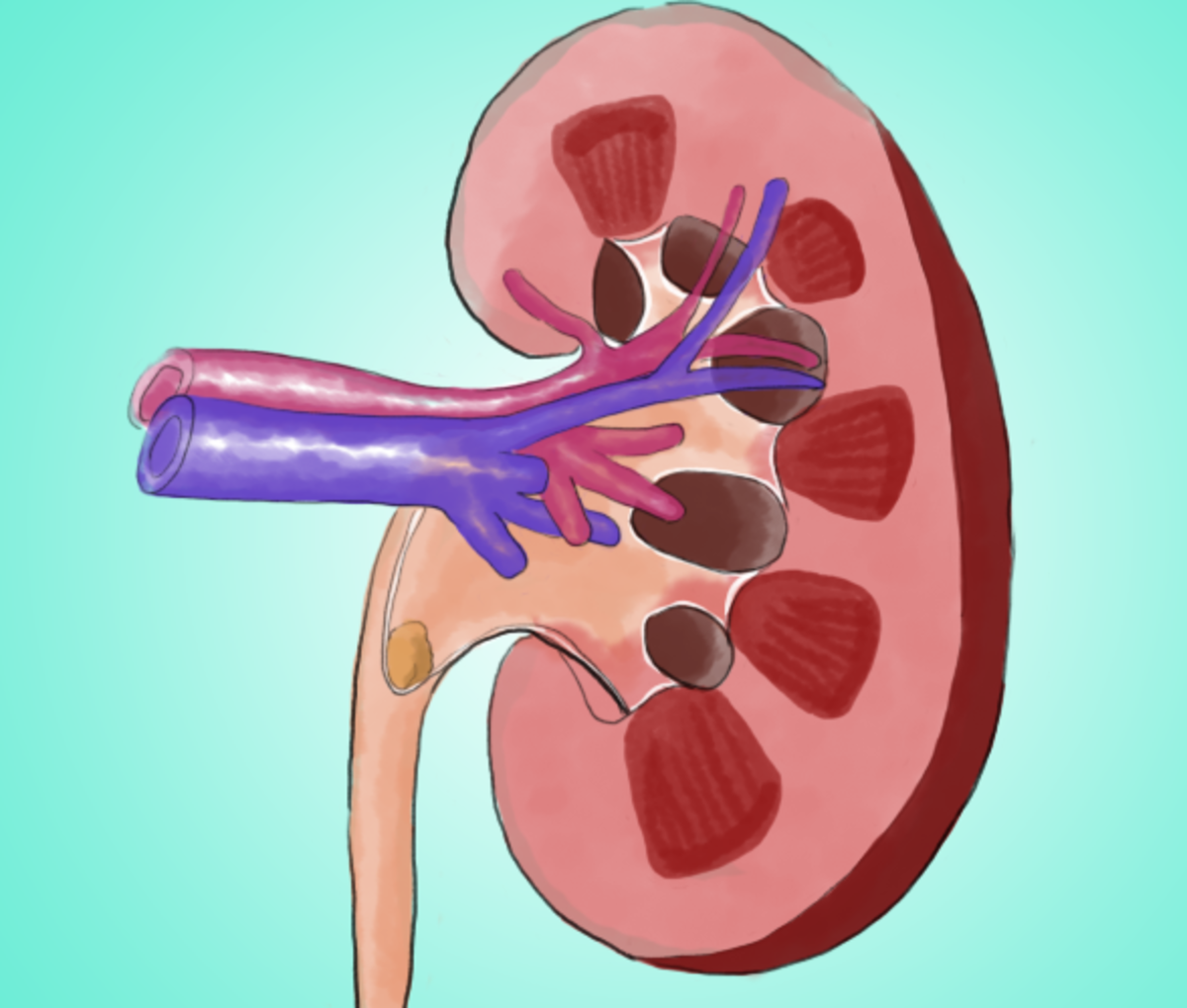 A kidney stone (dark yellow) in the ureter can block urine and create pain the sides and swollen kidneys.