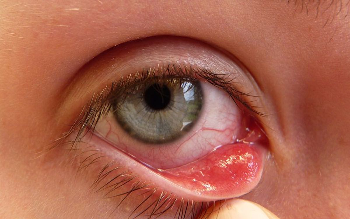 How To Get Rid of a Stye Overnight