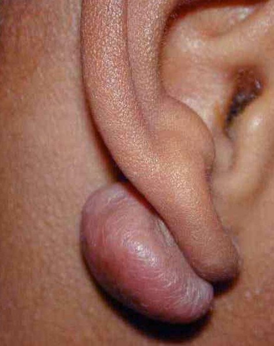 lump-behind-ear