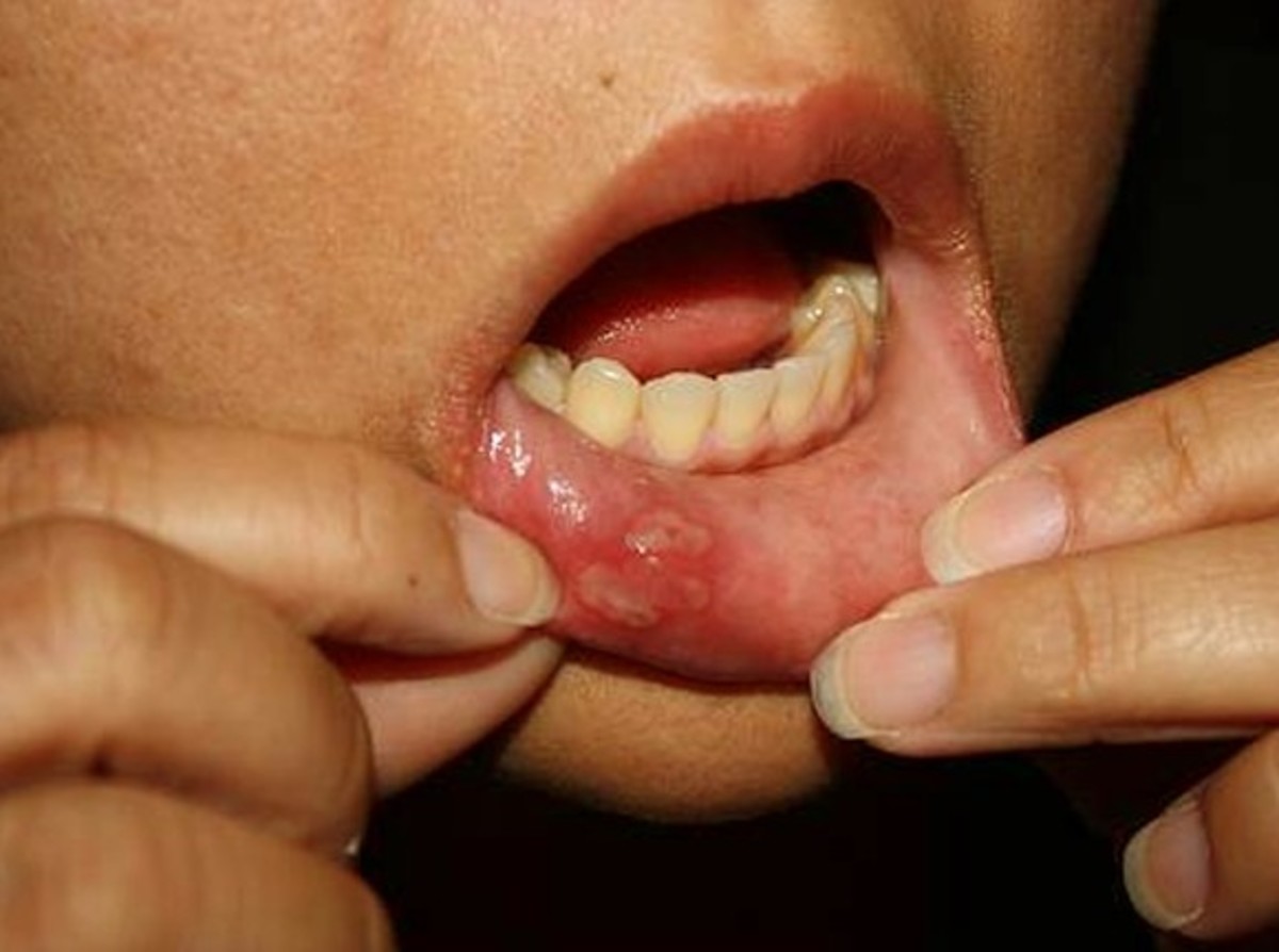 Blisters in Mouth - Symptoms, Treatment, Causes, Pictures