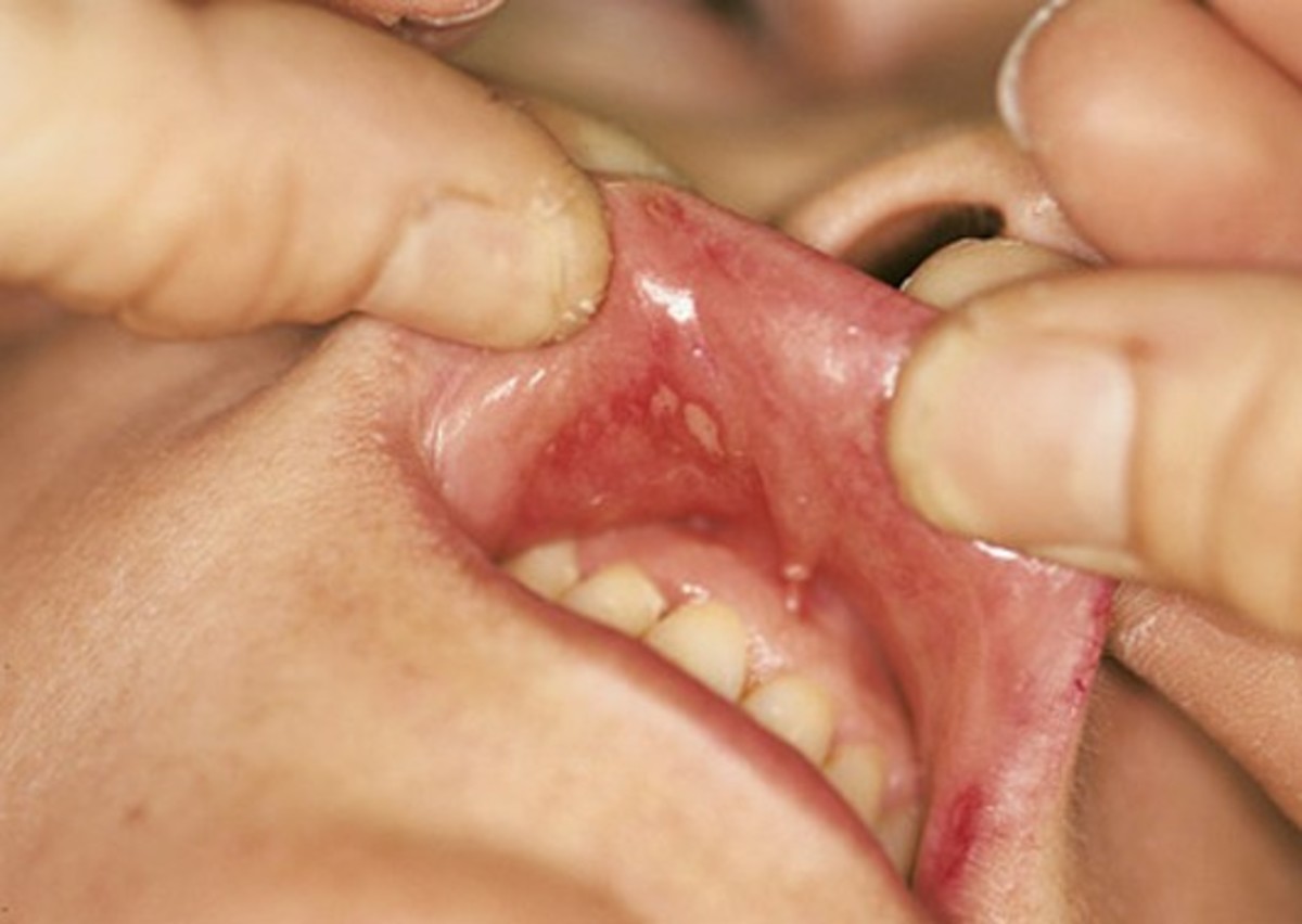 blisters-in-mouth