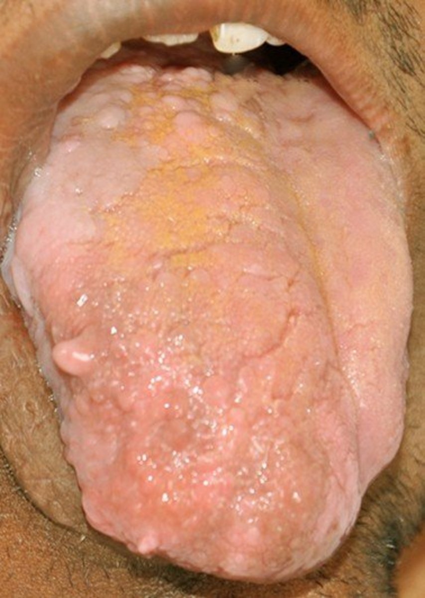 Tongue papillae inflammation treatment - Papilloma trasmissione