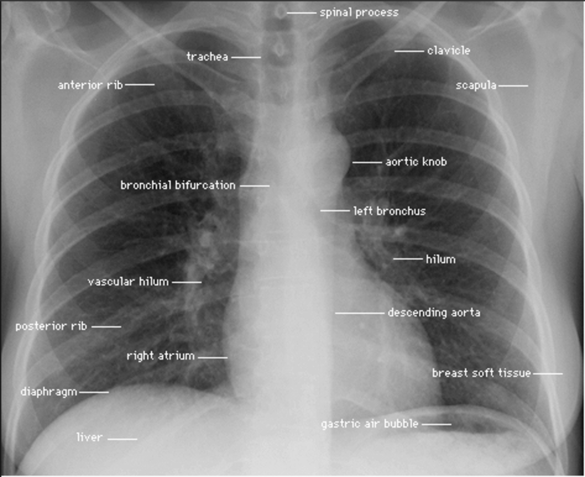 A normal chest x-ray showing all contours, the two lung parenchyma and pulmonary vessels with the bronchi branches