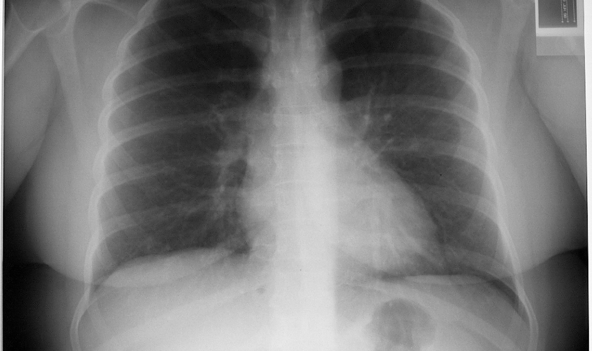 The solitary pulmonary nodule detected on chest x-ray is a common clinical problem. Risk factors for malignancy in this situation are older age, smoker, occupational exposure to carcinogens, increasing size of lesion (80%   3cm), irregular border.
