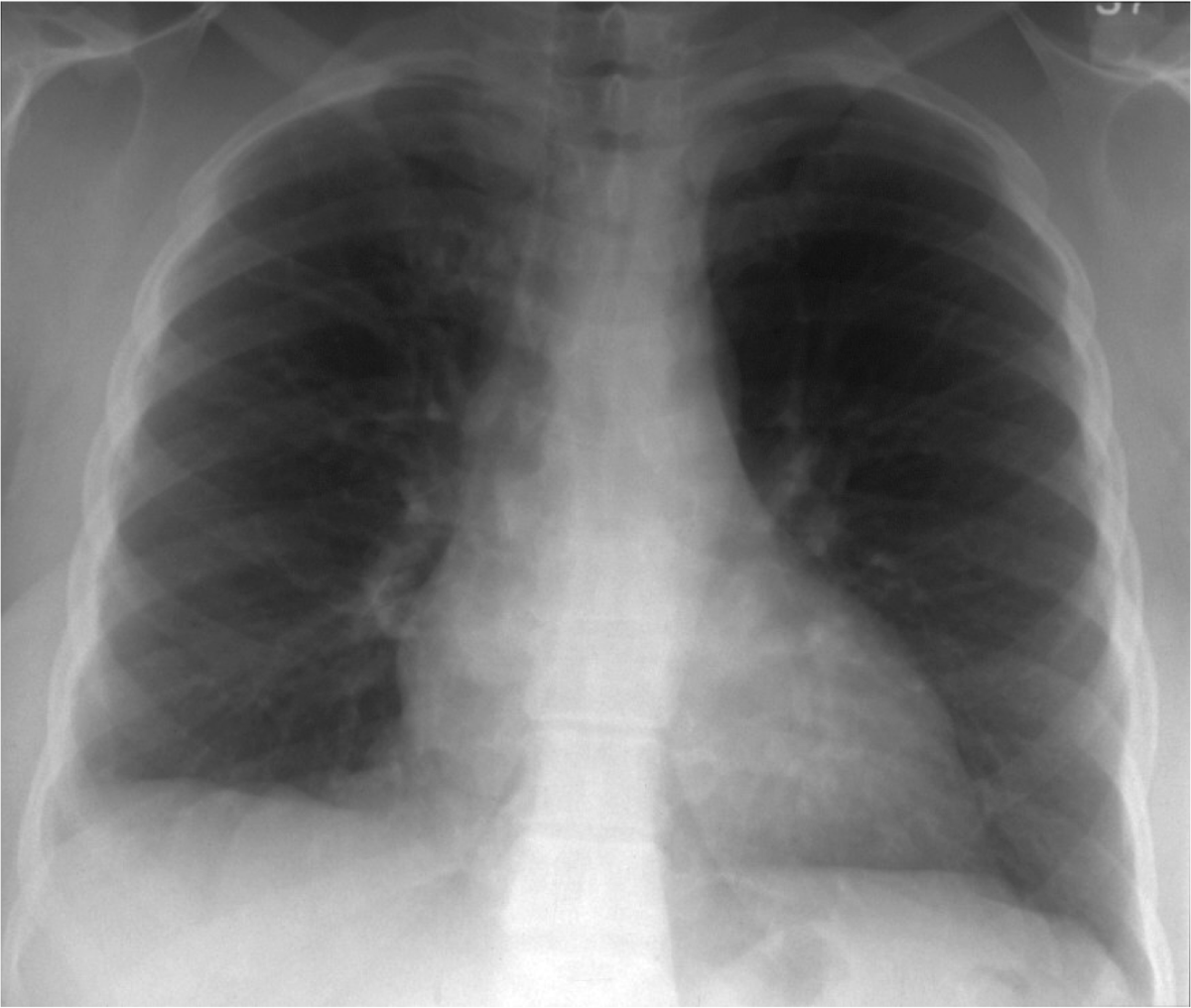 A normal chest x-ray showing all contours, the two lung parenchyma and pulmonary vessels with the bronchi branches