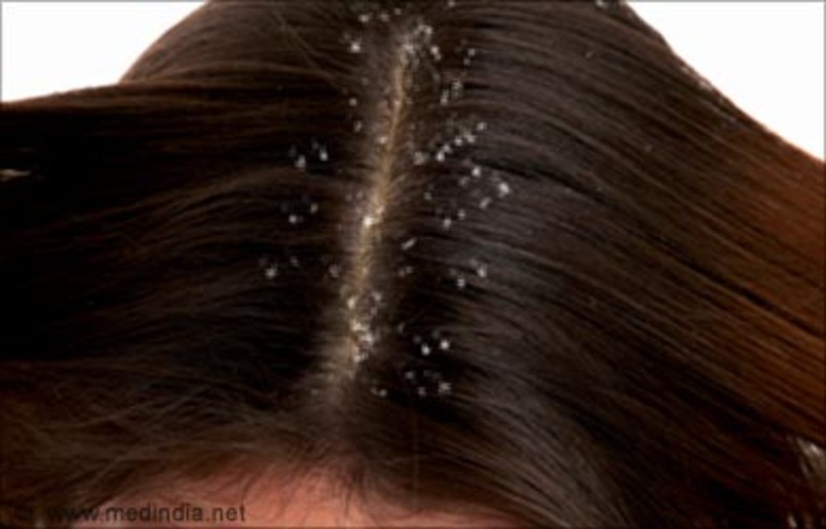 Hair Affected by Dandruff