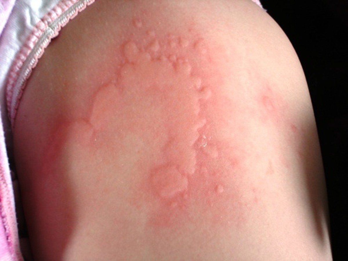 causes-and-treatment-options-for-hives