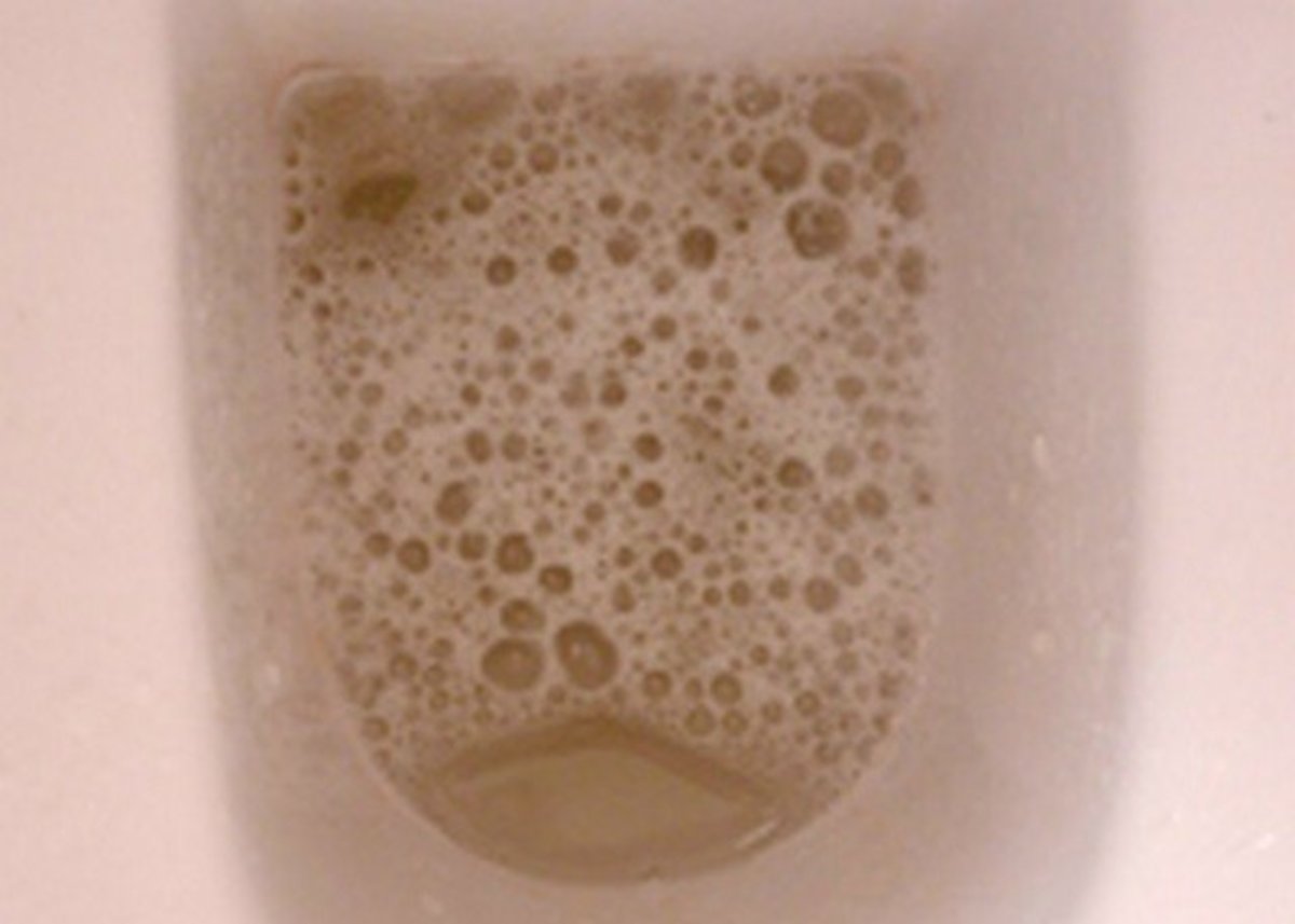 How is foamy urine treated?