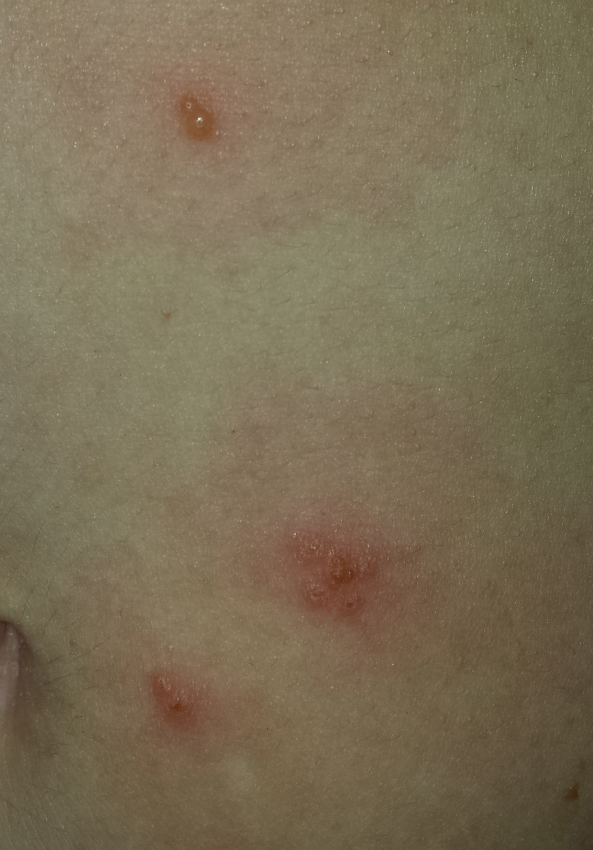 Day Seven of my shingles rash. Hopefully, this is as bad as it will get. The blister at the top is new. The red lesions are old blisters, but they still hurt.