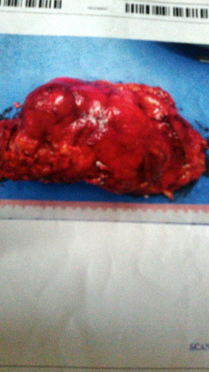 Left kidney and tumor taken from my body in operation on April 26, 2015