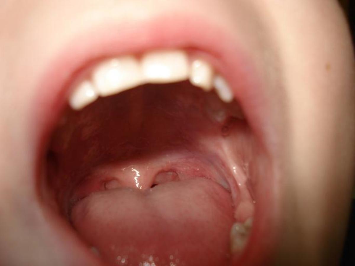 Tonsil Stones: Here's How to Get Rid of Them Without Hurting Yourself
