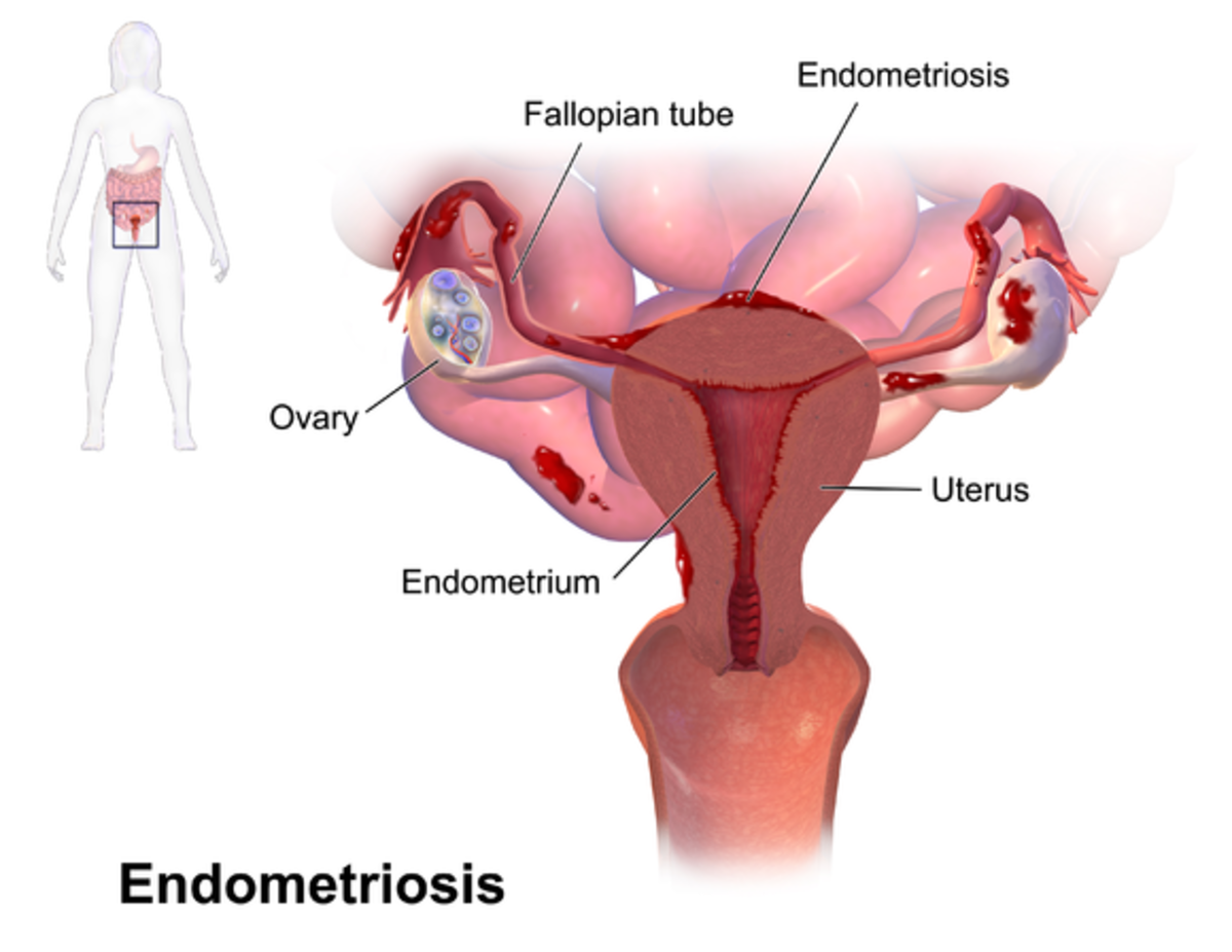 Endometriosis - A Women Disease