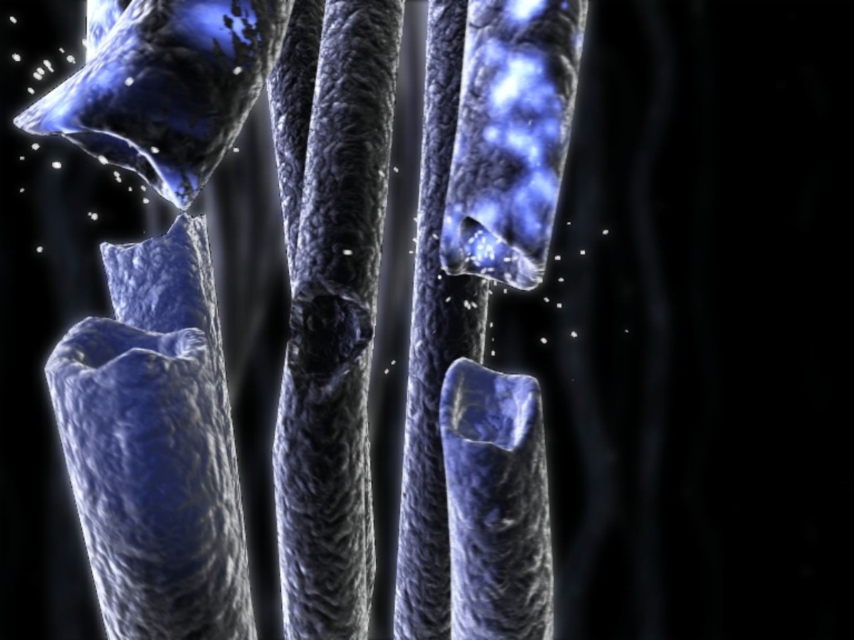 Neuropathic pain is caused by damage to nerves throughout the body.