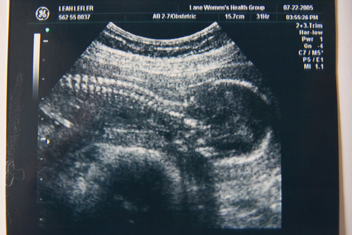 A baby at 18 weeks gestation. The spinal column is clearly defined in this ultrasound image.