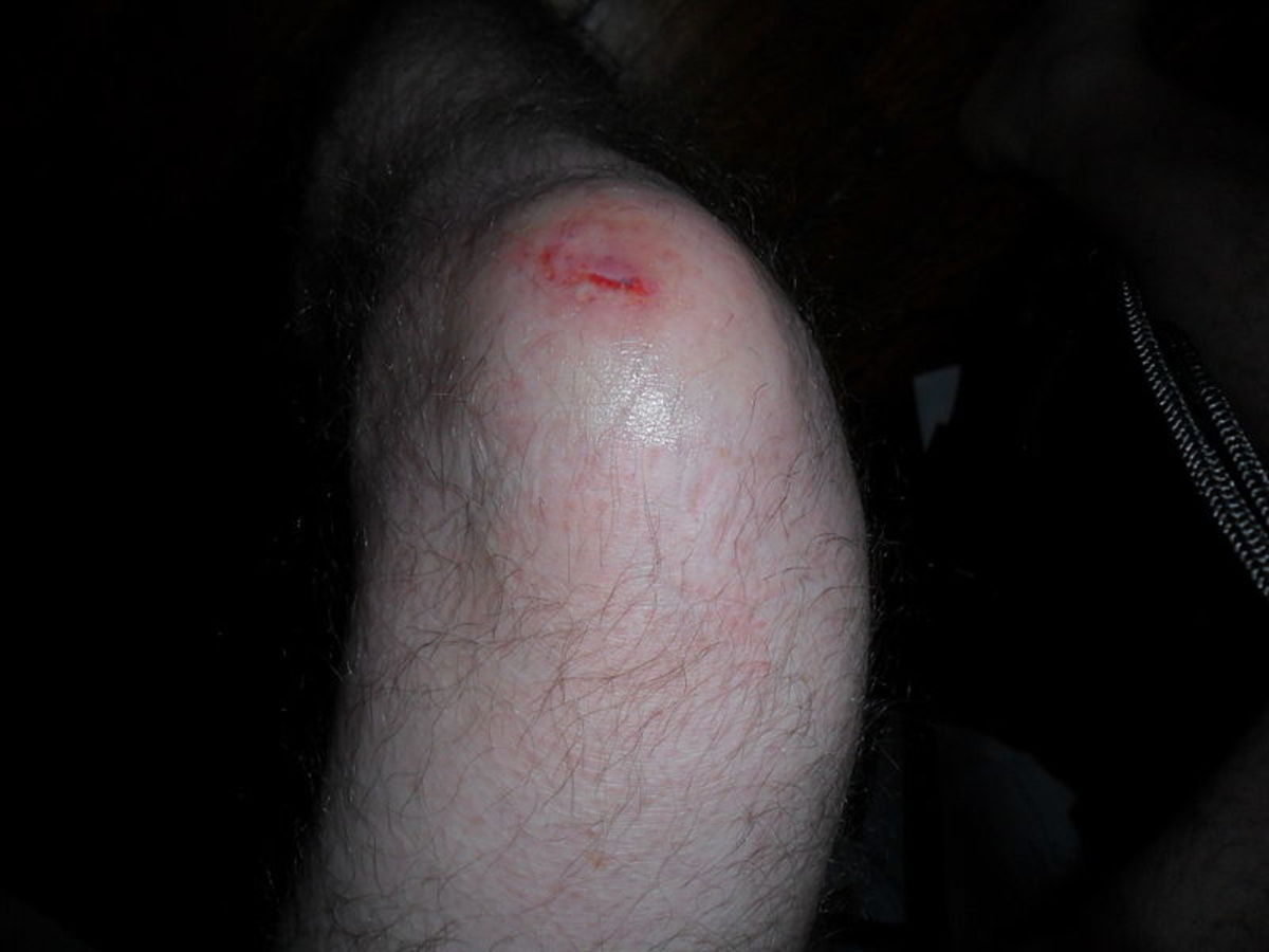 A lacerated knee with inflammation