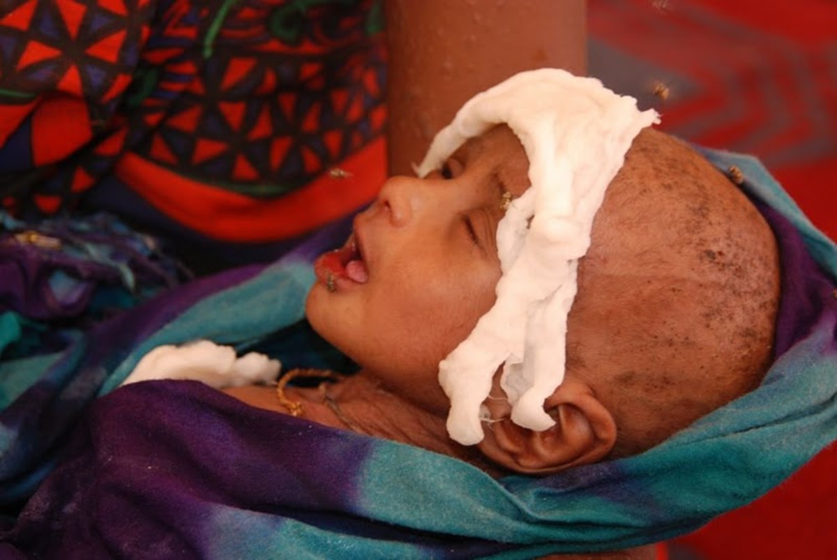 A severely malnourished Somali boy receiving treatment at a health centre.