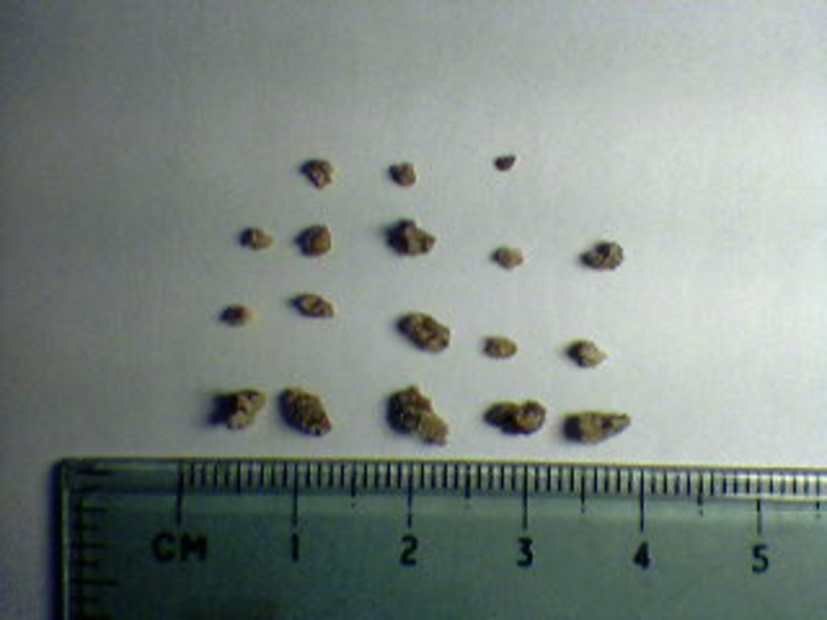 Kidney stones come in many different sizes..