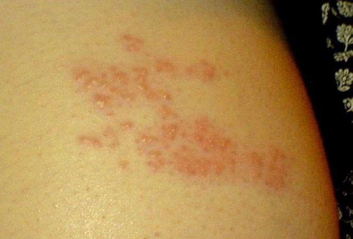 Shingles rash during an outbreak of the Herpes zoster virus