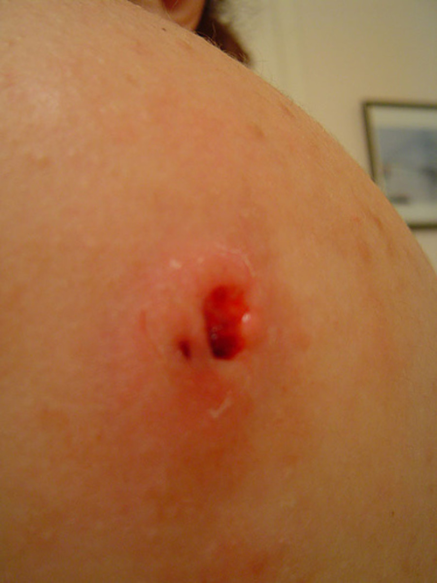 Shoulder boil that is already draining fluids, it is very contagious at this point so be sure to keep the area clean.