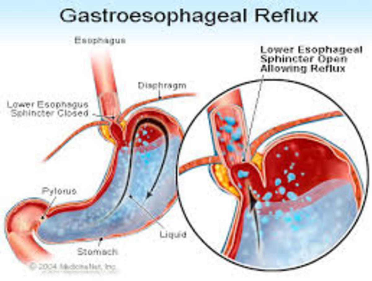 Coping With GERD (Gastro-Esophageal Reflux Disease)