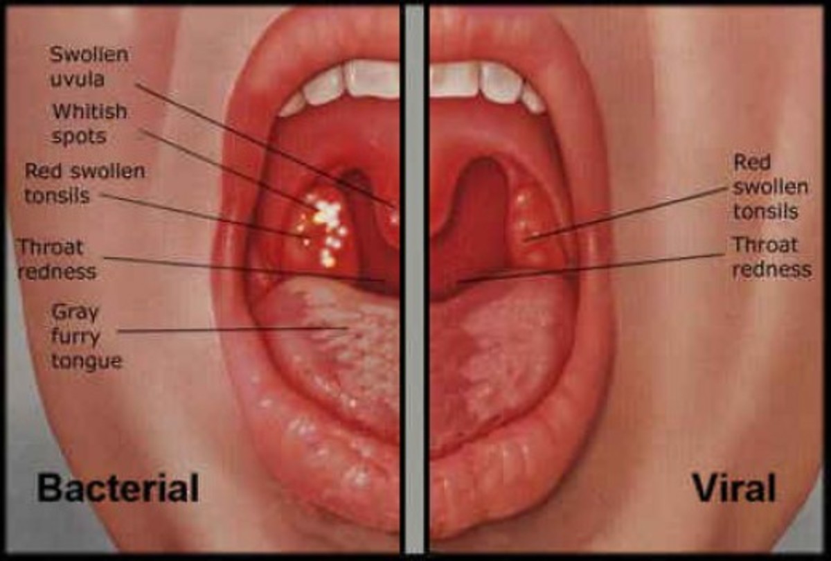 VIRAL AND BACTERIAL SORE THROAT DIFFERENCE visual data 6