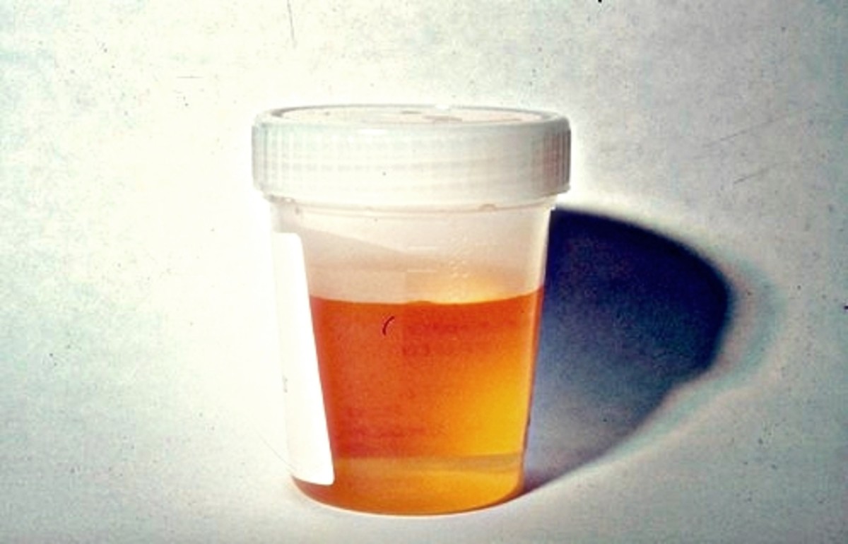 Orange Urine – Causes, Symptoms, Diagnosis,Treatment
