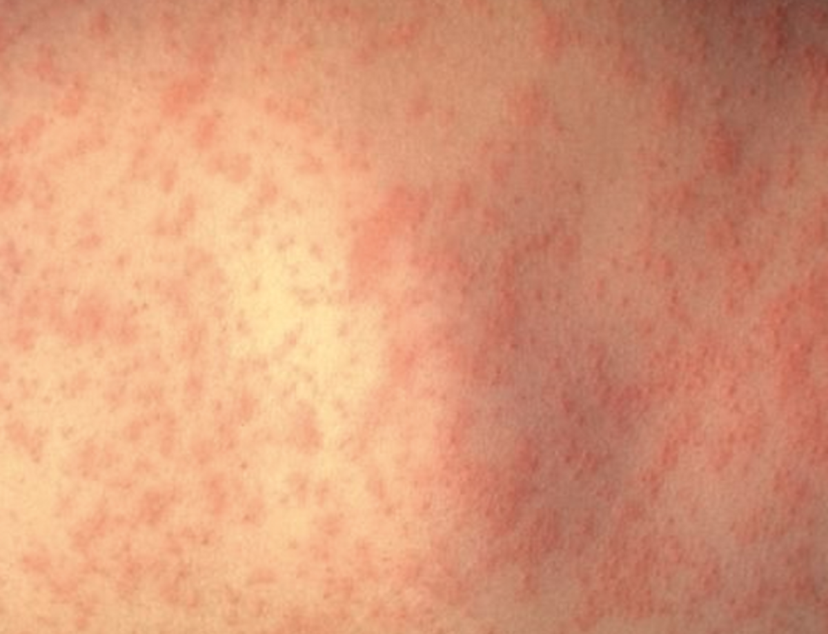 hiv-skin-rash-images-causes-symptoms-treatment
