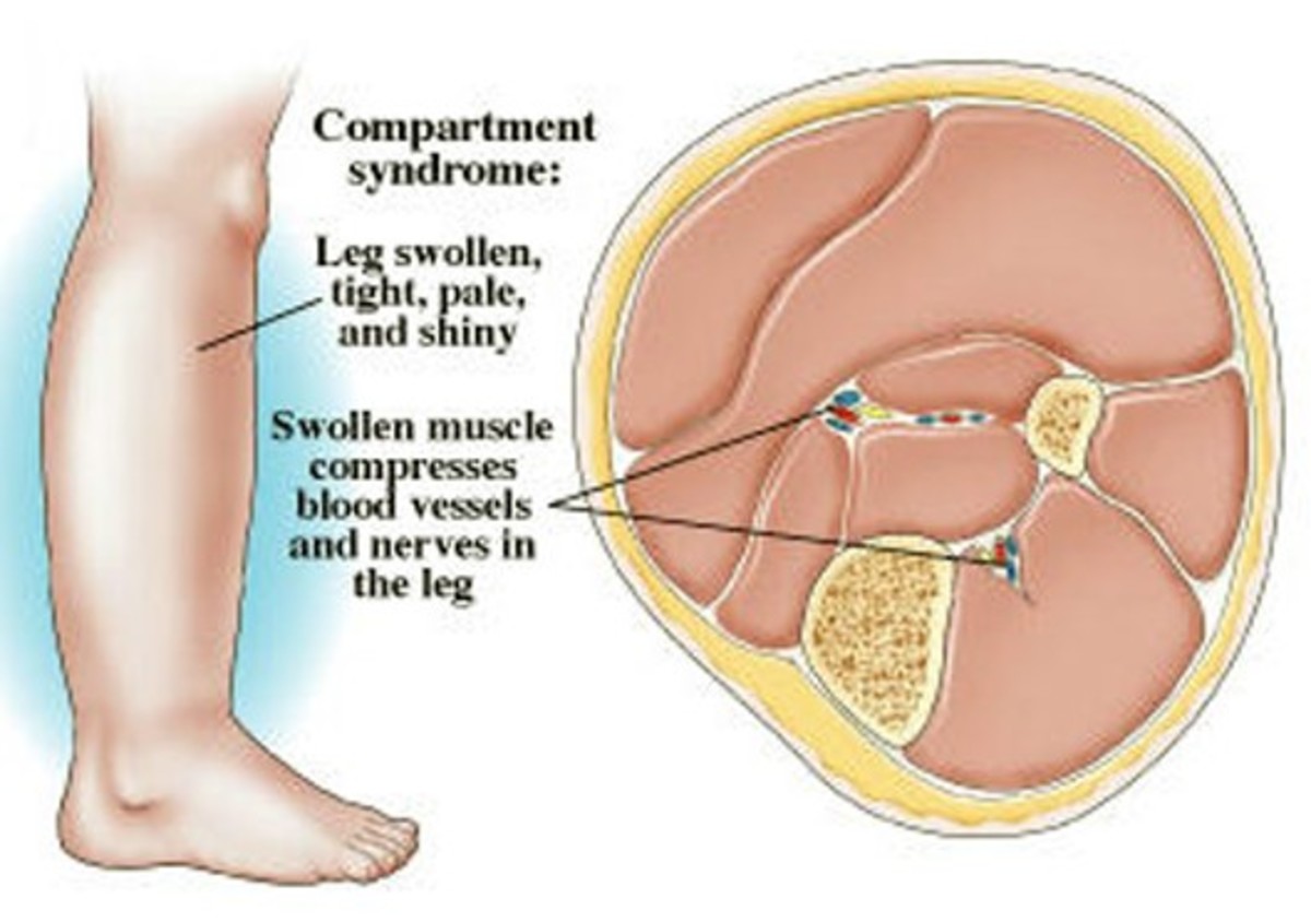 Compartment Syndrome Pictures Treatment Causes Surgery HubPages