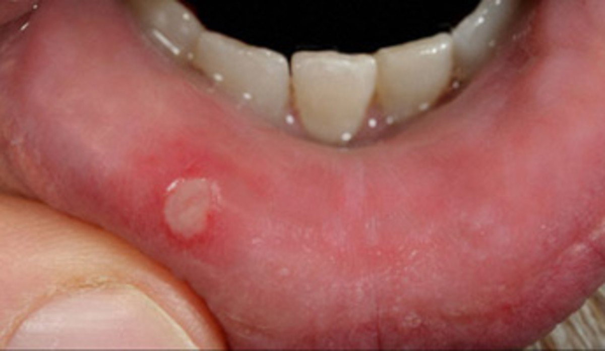 9-treatments-for-ridding-your-mouth-of-ulcers