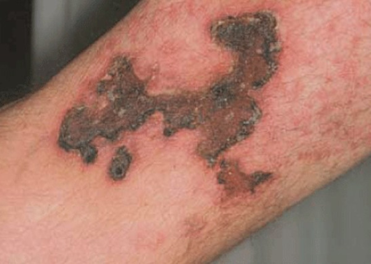 Calciphylaxis - Pictures, Symptoms, Diagnosis, Treatment, Causes