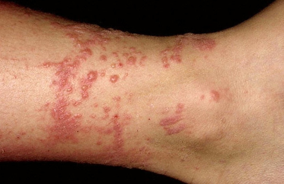 contact-dermatitis-pictures-symptoms-causes-treatment
