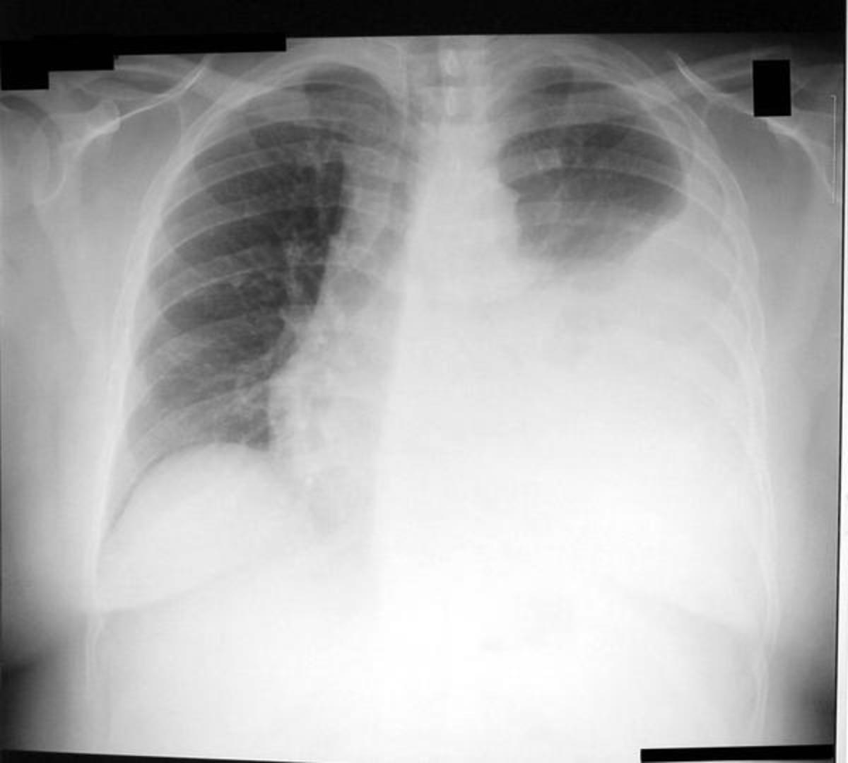 Sometimes an x-ray is taken while lying on the painful side. This may show fluid, as well as changes in fluid position, that did not appear in the vertical x-ray.