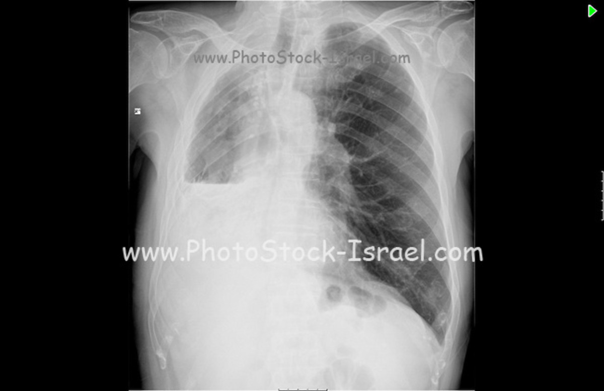 Pleurisy In Chest XRay Various Radiographs To Show And Depict This