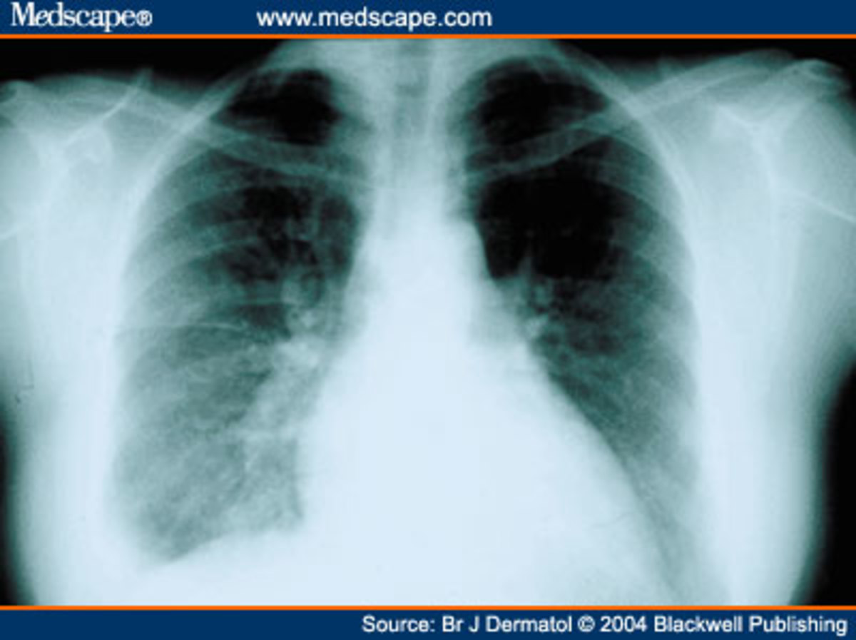 Pleurisy In Chest XRay Various Radiographs To Show And Depict This