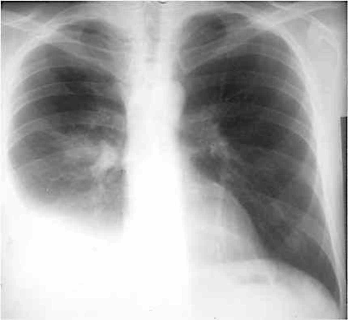 Pleurisy In Chest X-Ray: Various Radiographs To Show And Depict This ...