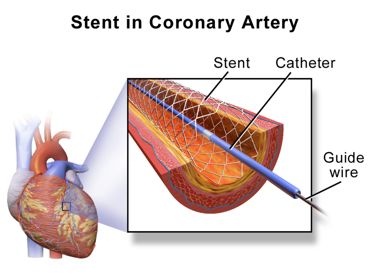 An angioplasty is a common treatment for blocked arteries and silent heart attacks