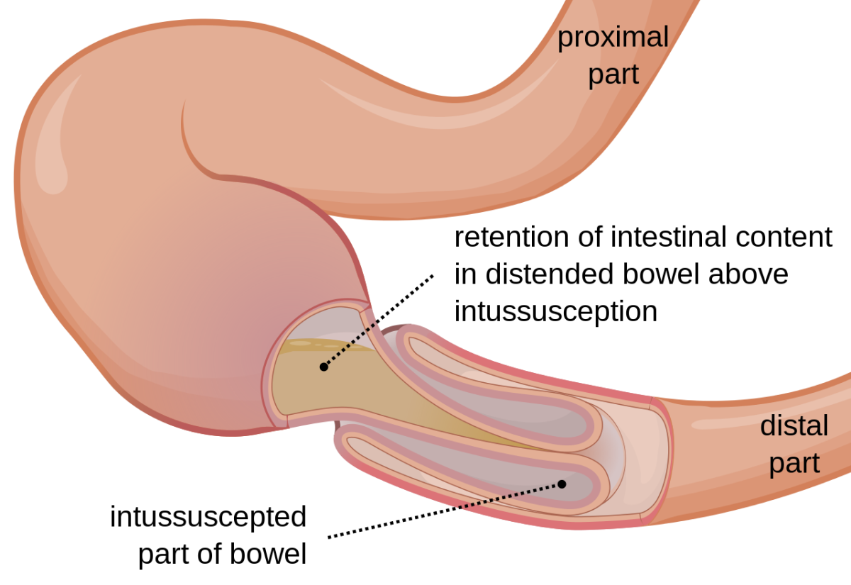Diagram showing an intussusception of the bowel