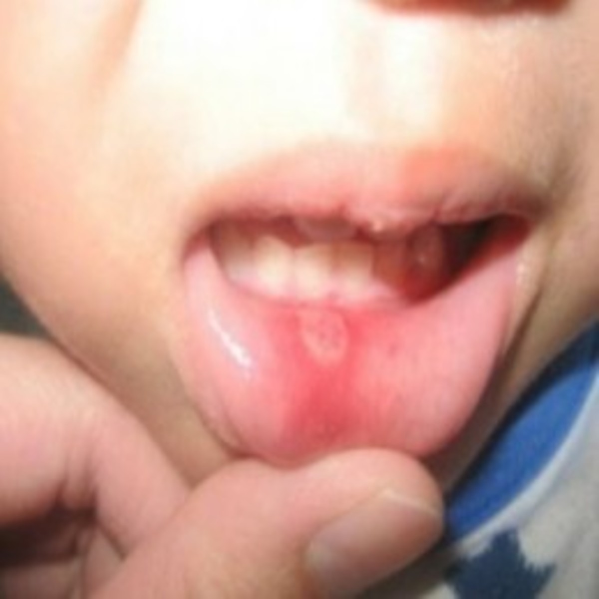 Oral ulcers are just one of the ways that lupus manifests itself.