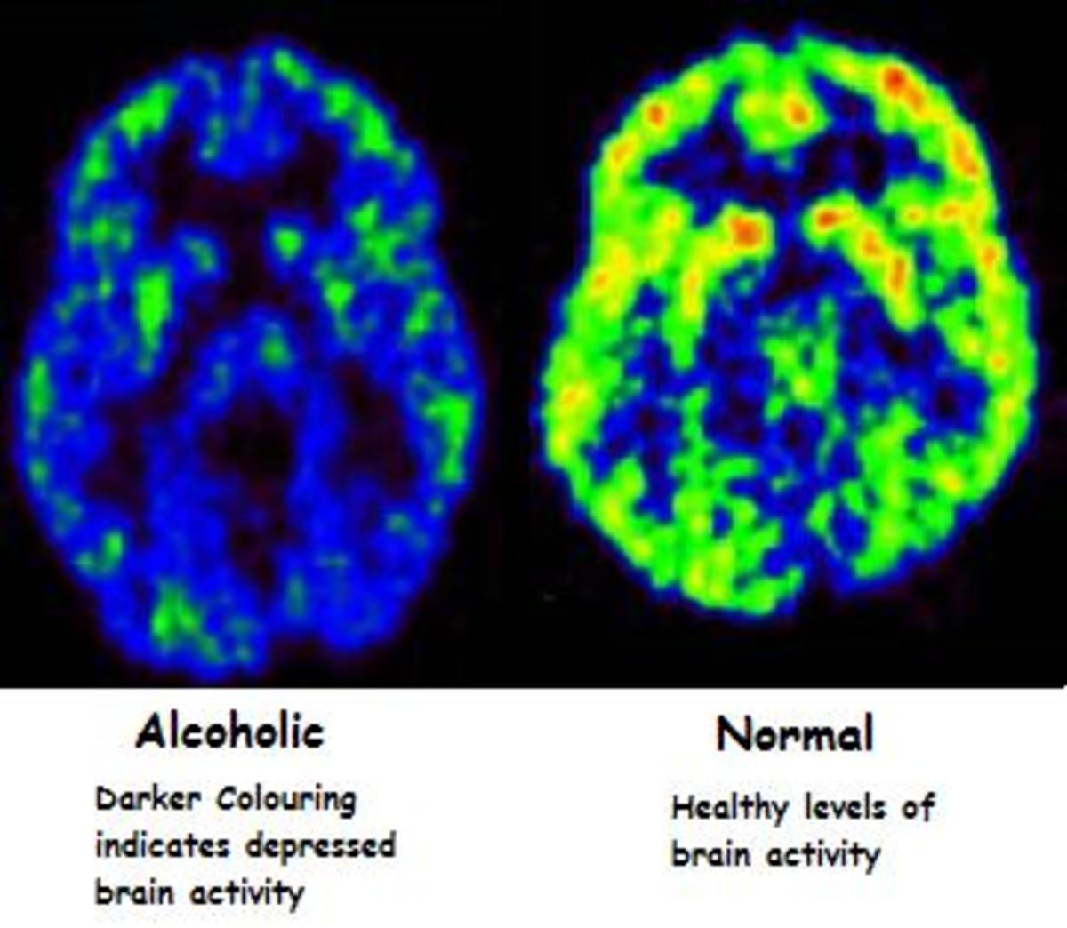 what-alcohol-does-to-your-brain