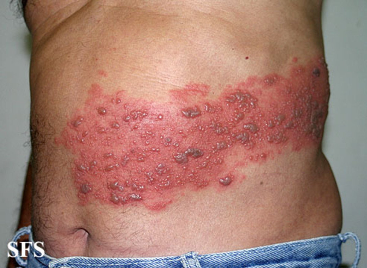 Herpes zoster (shingles)