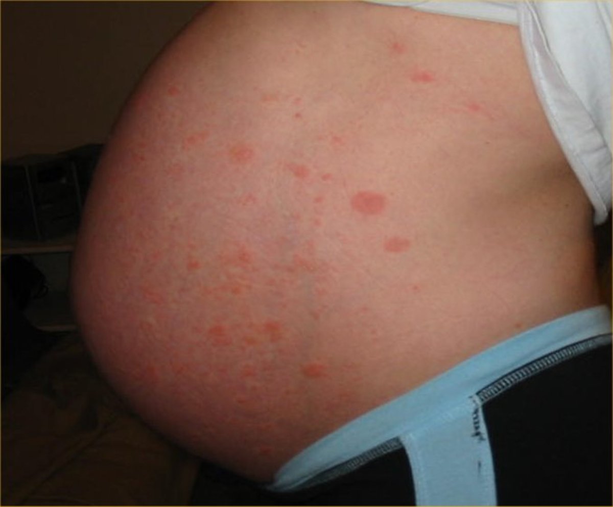 Pruritic urticarial papules and plaques of pregnancy (PUPPP)