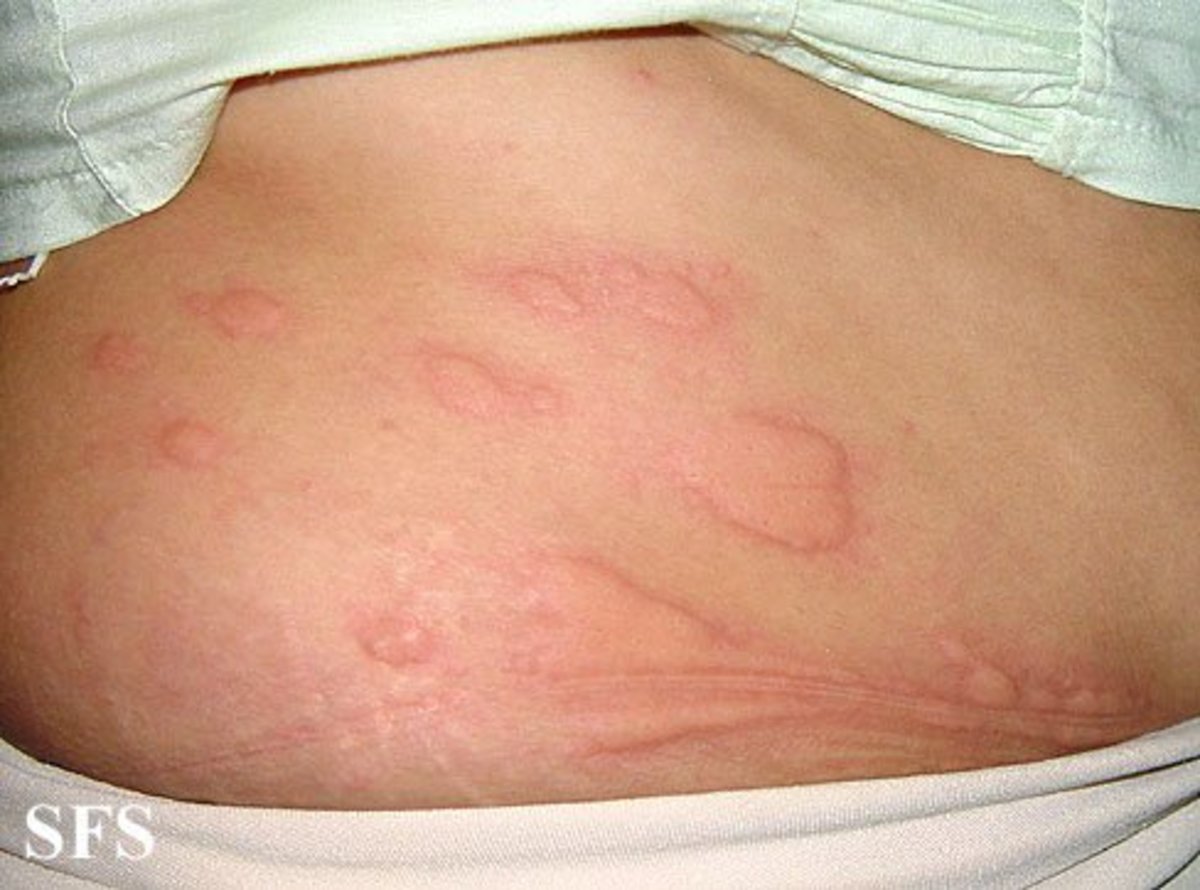 Patchy hives (urticaria)