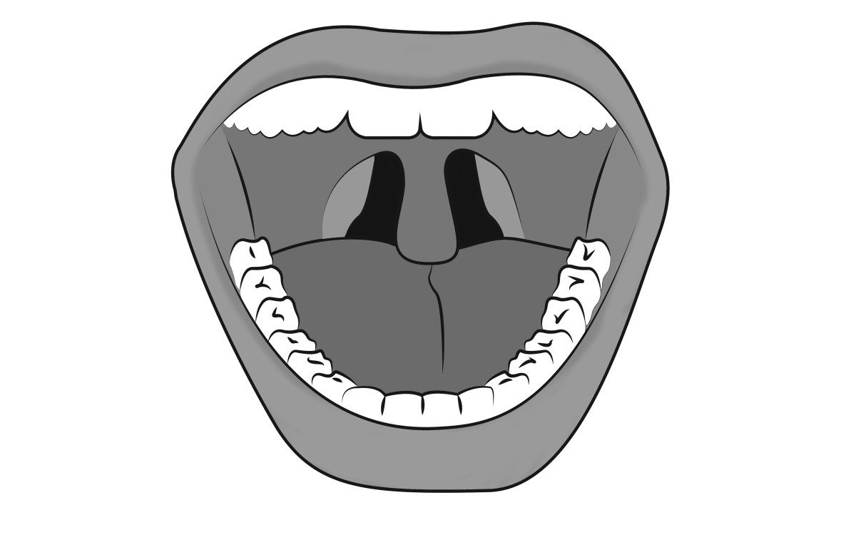 An enlarged uvula may touch the tongue