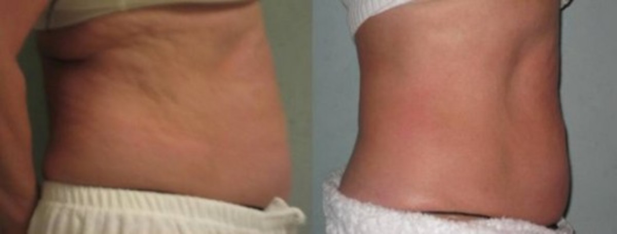 12 Easy Ways to Get Rid of Cellulite From Thighs, Buttocks, Hips, and Lower Stomach