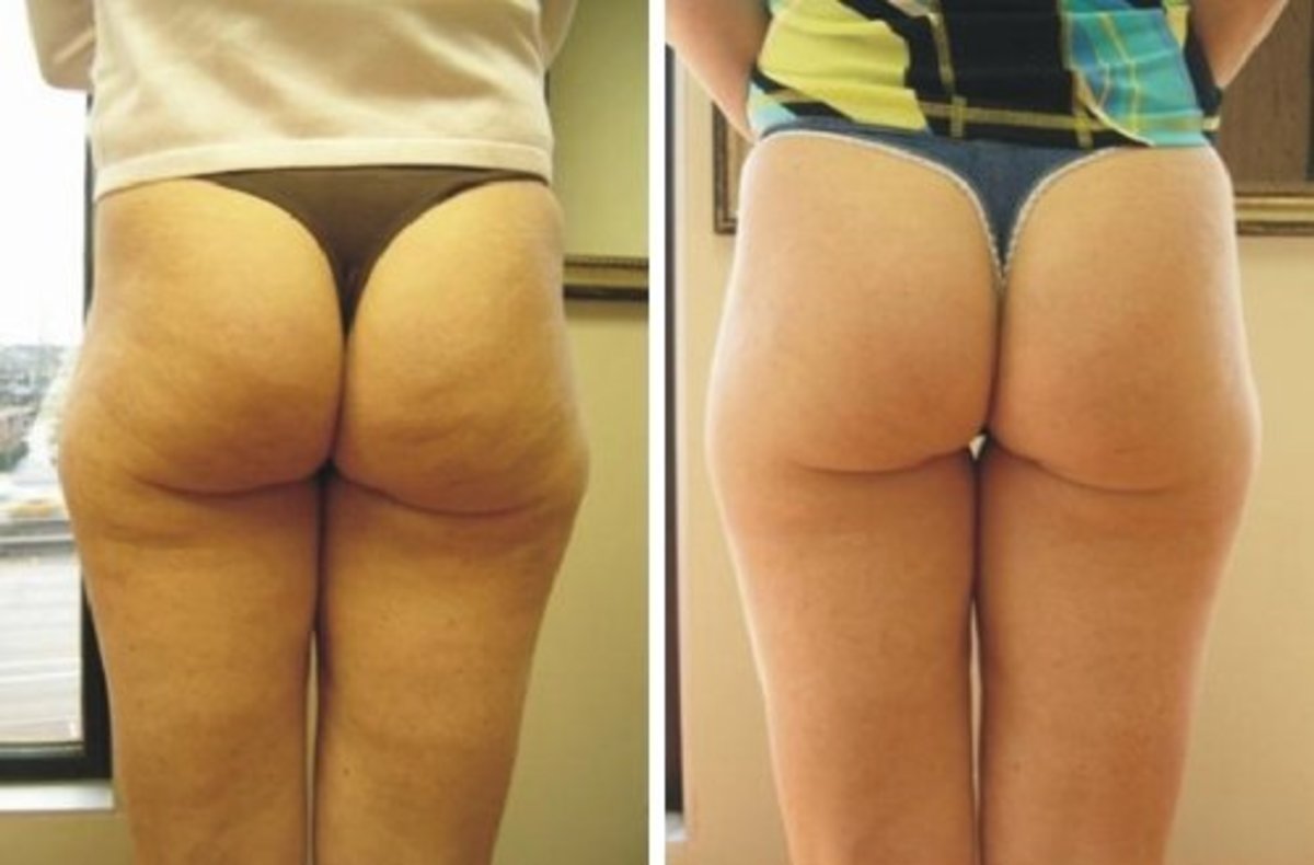 12-easy-ways-to-get-rid-of-cellulite-from-thighs-buttocks-hips-and-lower-stomach