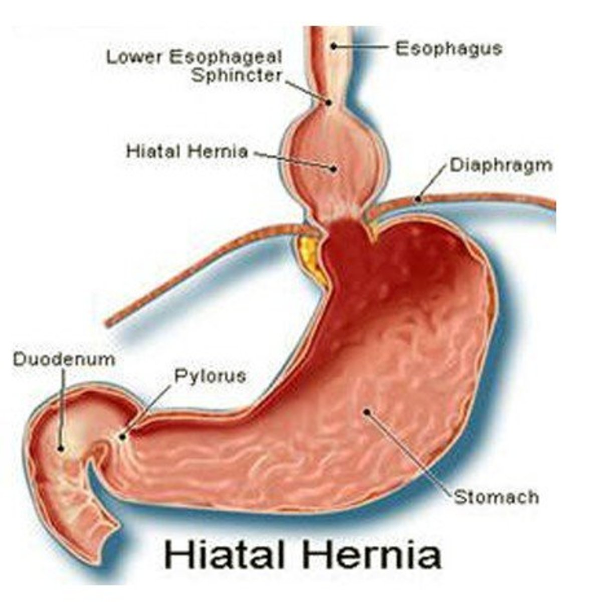 Hiatal Hernia - Pictures, Symptoms, Treatment, Recovery time, Surgery
