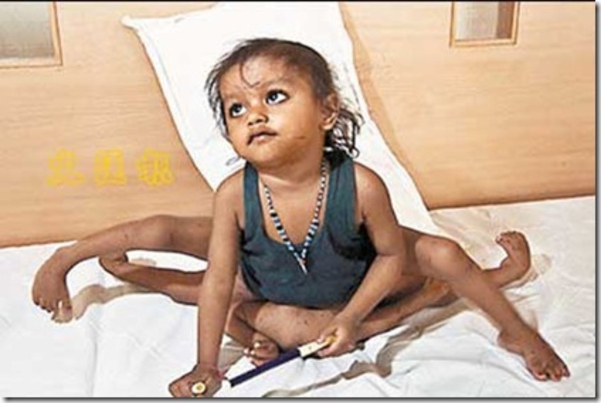 Parasitic Twins - A Record of Cases in India
