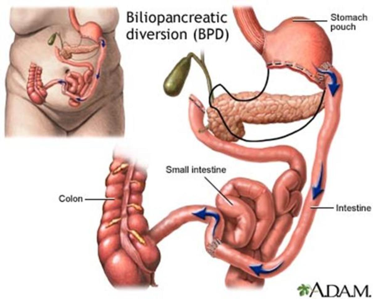 In a BPD procedure, portions of the stomach are removed. The small pouch that remains is connected directly to the final segment of the small intestine, completely bypassing the upper part of the small intestines. A common channel remains in which bi