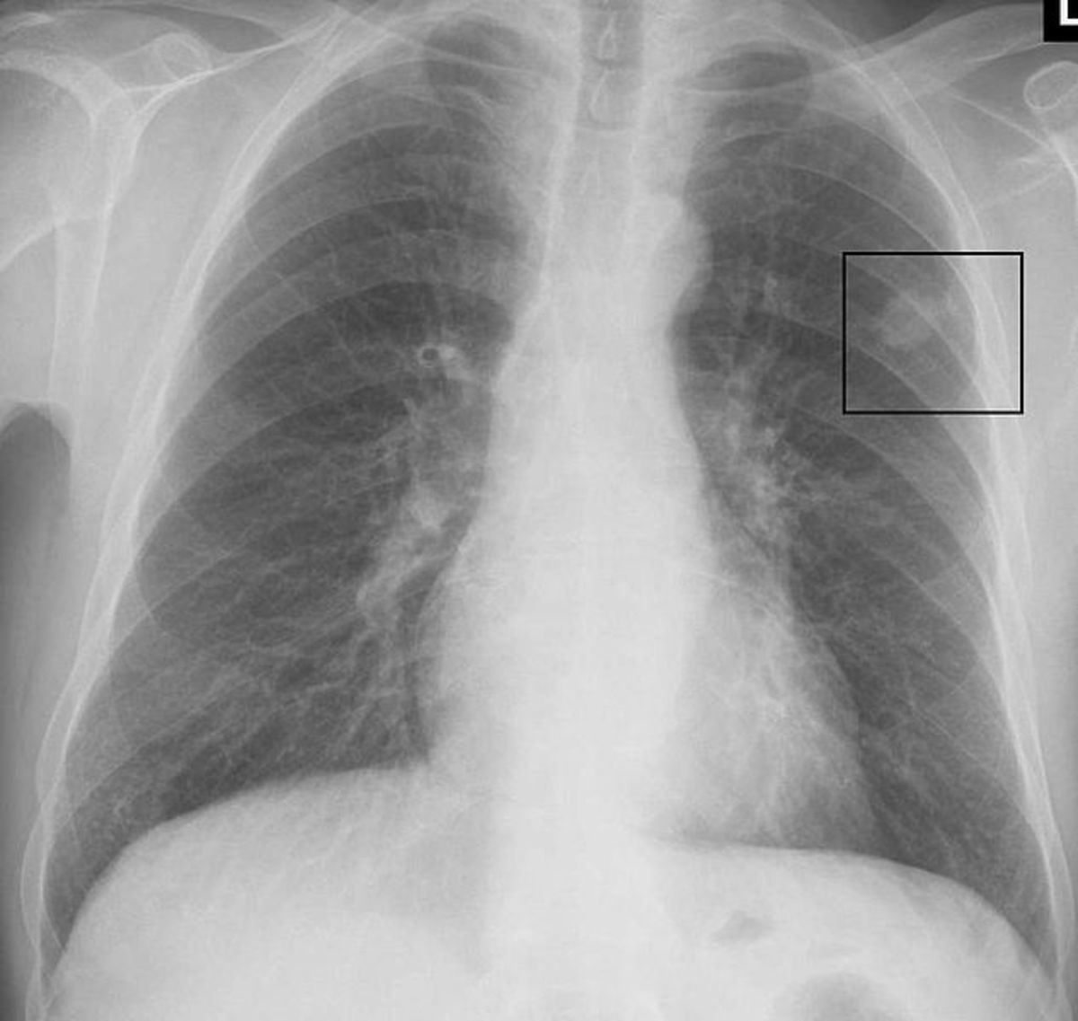 Dark Lung Spots on X-Ray